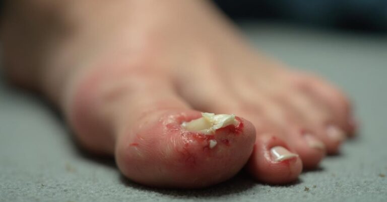 Que faire quand ongle pied se detache causes solutions lonychomadese featured
